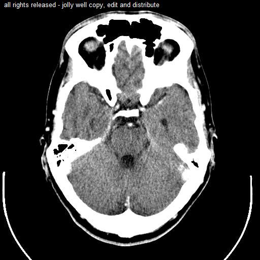 Brain CT Scan